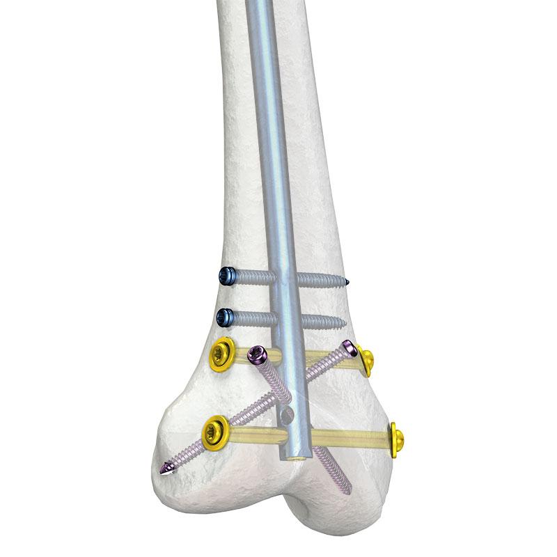 Стержень ретроградний виростковий блокований для стегнової кістки CHARFIX2